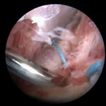 Arthroscopic shoulder stabilization by means of Bankart repair and remplissage
