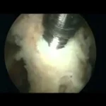 Stabilizzazione artroscopica della spalla secondo Latarjet-Lafosse