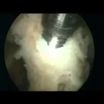 Arthroscopic shoulder stabilization according to Latarjet-Lafosse