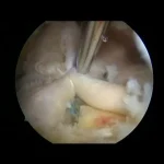Rotator cuff suture in multi-row technique and patch augmentation - version 1