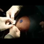 Rotator cuff suture in multi-row technique and patch augmentation - version 2