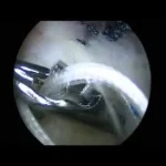 Rotator cuff suture in multi-row technique and patch augmentation - version 3